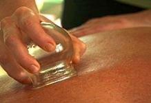acupuncture cupping therapy