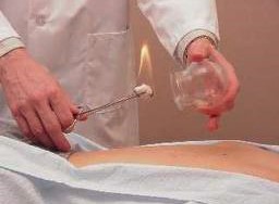 Cupping can help your pain 